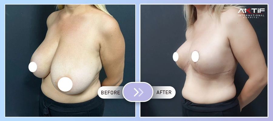 Breast Reduction Surgery