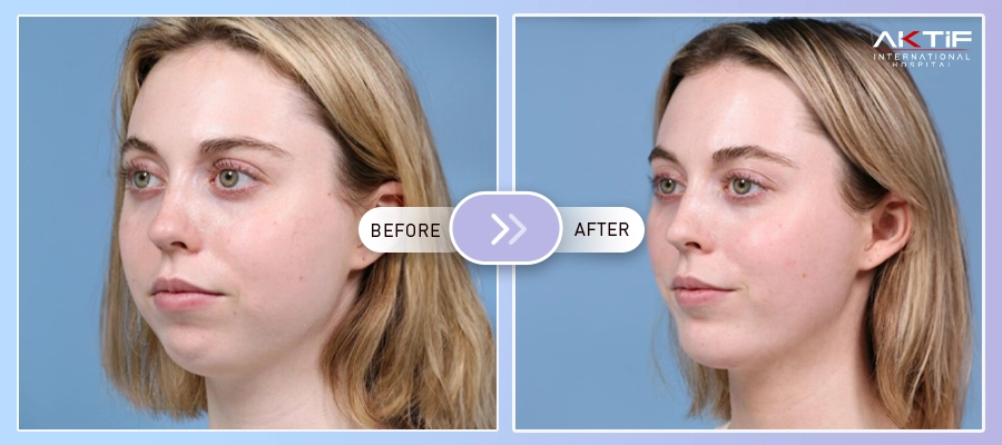 Buccal Fat Removal