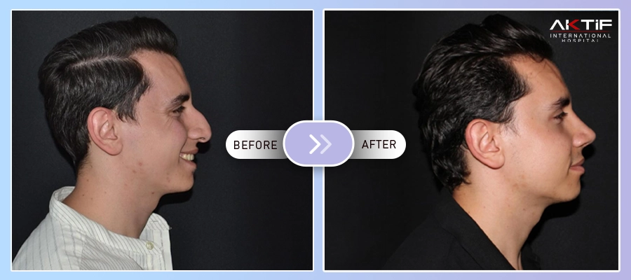 Rhinoplasty Before-After