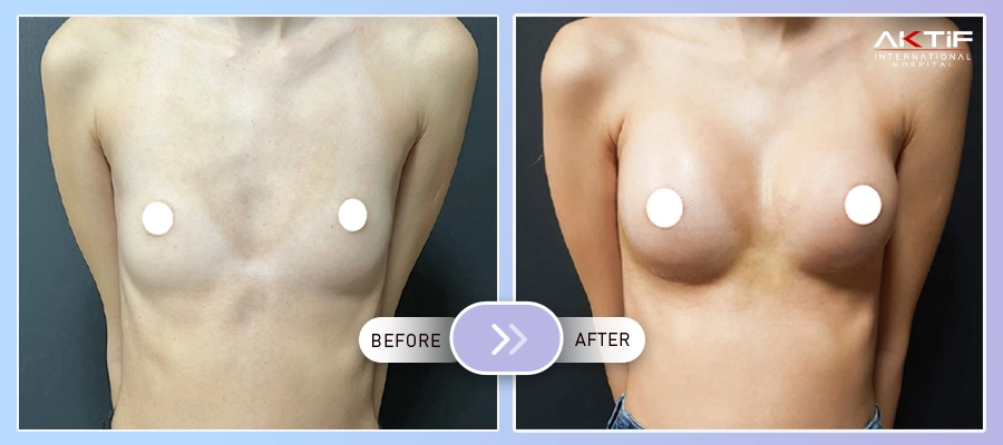 Silicone Breast Implant