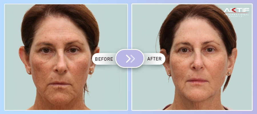 Facial Fat Injection Surgery