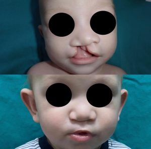 Cleft Lip Treatment (1)