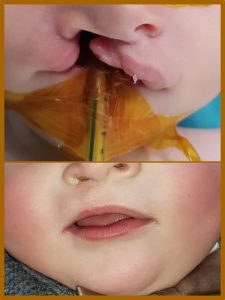 Cleft Lip Treatment (2)