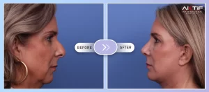 Chirurgie du lifting facial Avant Après