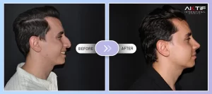 Rhinoplastie Avant-Après