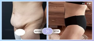 Tummy Tuck înainte - după